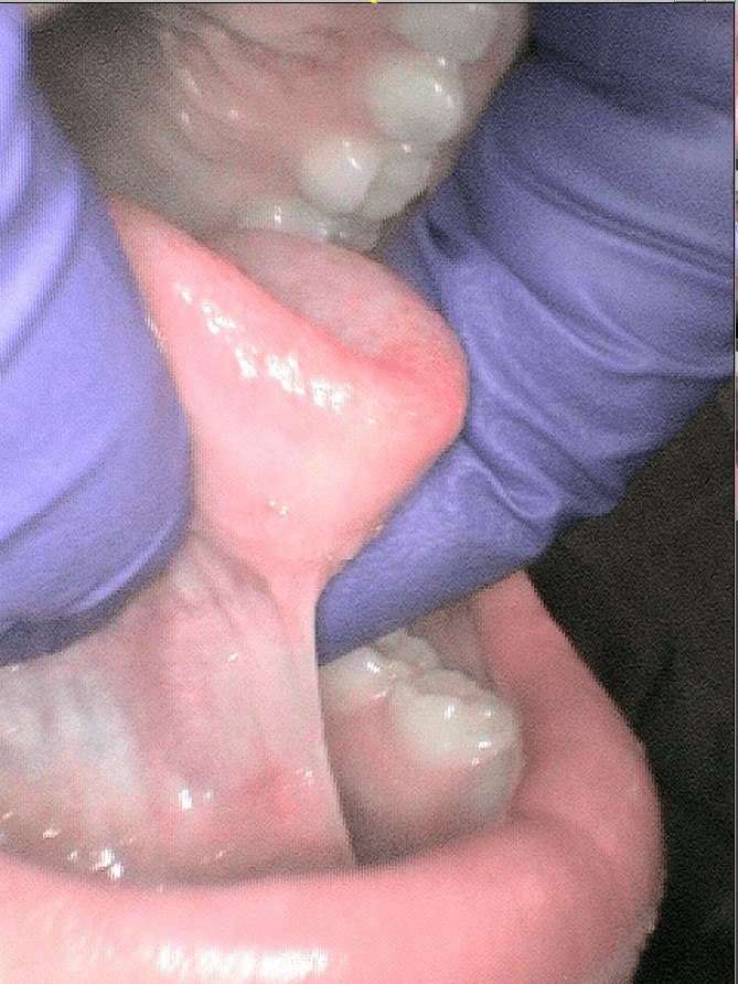Tongue Tie/ Frenectomy Before surgery