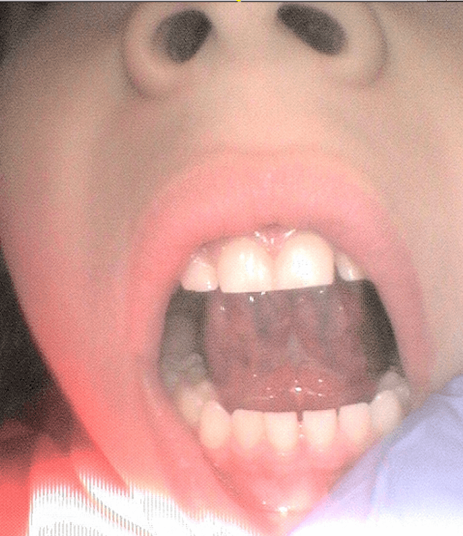 Tongue Tie Release surgery After 3  weeks