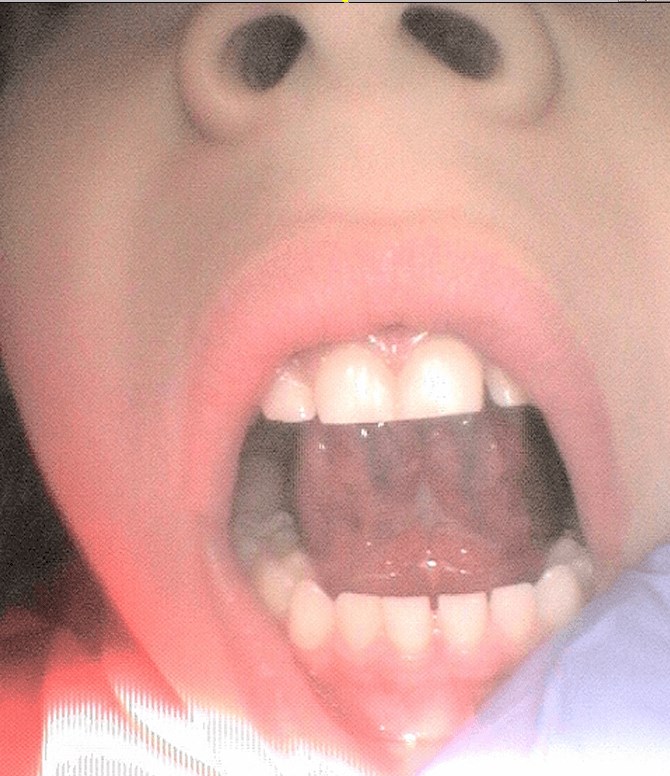 Tongue Tie Release surgery After 3  weeks