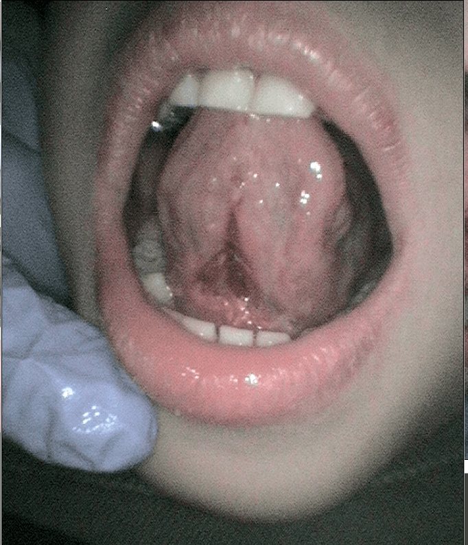 Tongue Tie Release surgery After Surgery