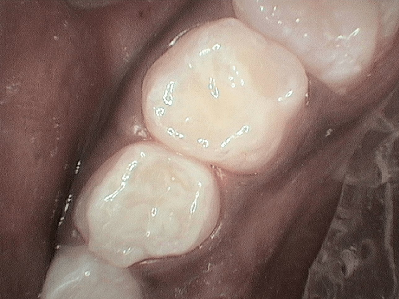 Tooth colored Fillings After