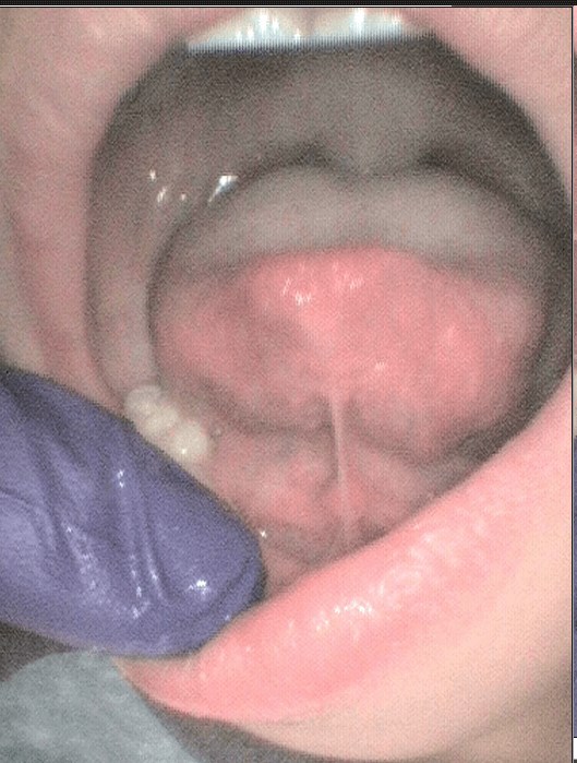 Tongue Tie/ Frenectomy Before surgery