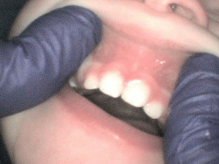 Lip Tie Release surgery After