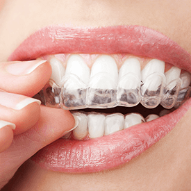 Invisalign® Treatment